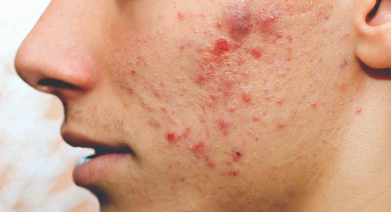Acne/Pimple Treatment