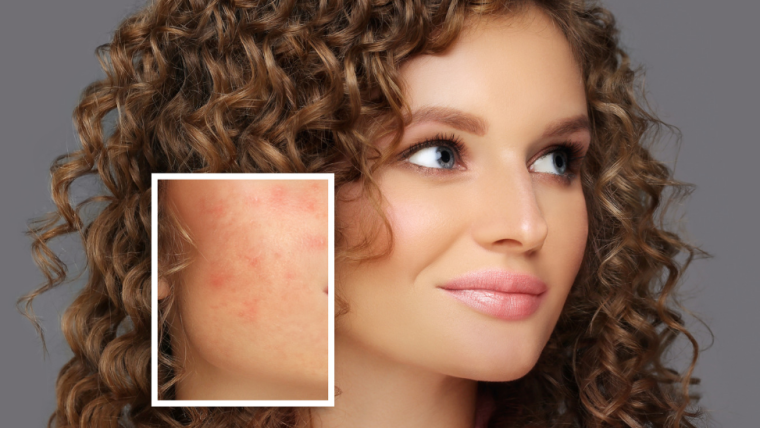 Acne Scar & Pigmentation