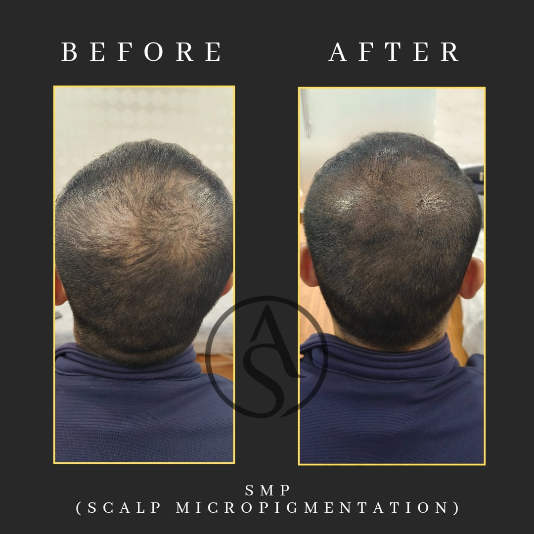 scalp-micropigmentation-treatment