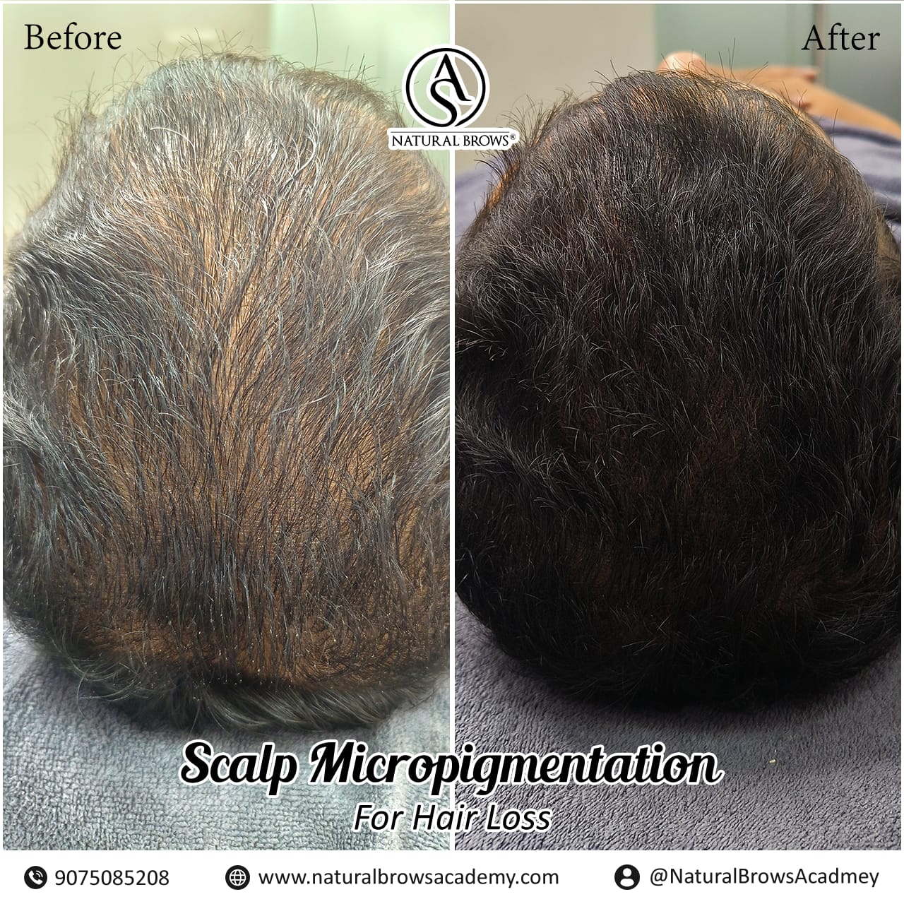scalp-micropigmentation