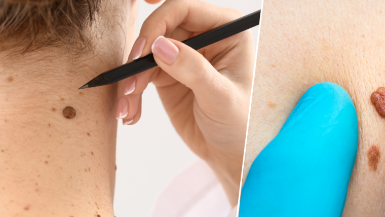 Mole & Skin Tag Removal