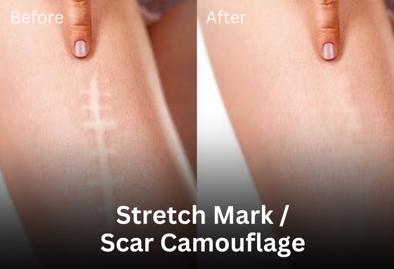 Can scars be camouflaged with skin tone tattoo ink? - Ink Illusions