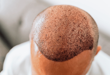 Scalp-micro-pigmentation